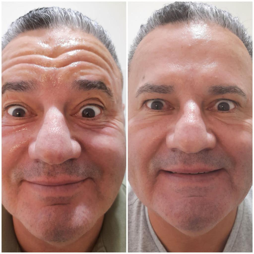 Botox