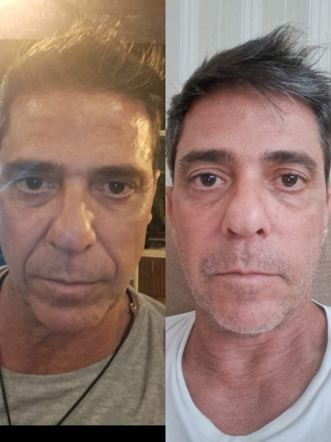 Preenchimento com Ácido Hialurônico